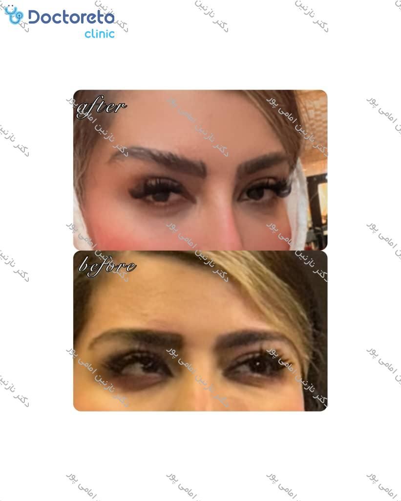 تزریق بوتاکس صورت (پیشانی، خط اخم، پنجه کلاغی)💉