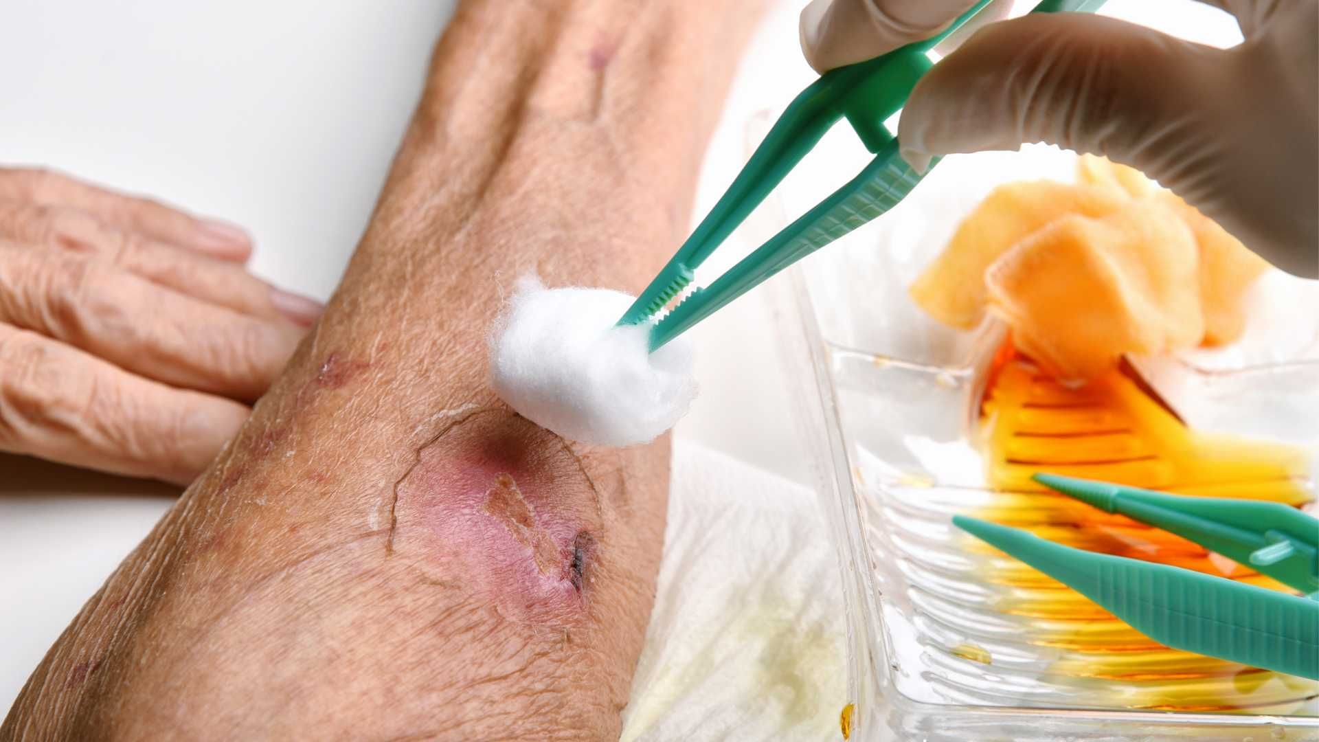 درمان زخم دیابتی و عفونی