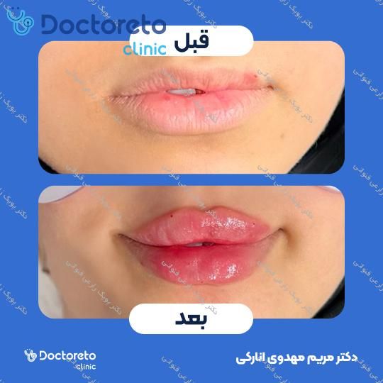 تزریق ژل لب