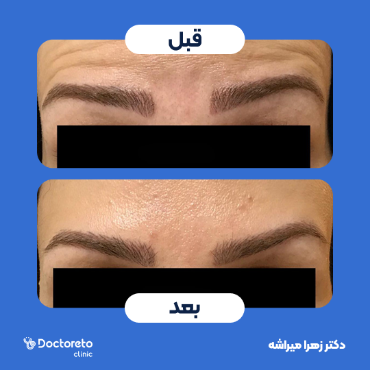 تزریق بوتاکس صورت (پیشانی، خط اخم، پنجه کلاغی)💉