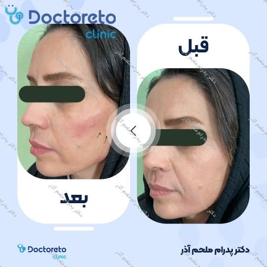 تزریق ژل زاویه فک