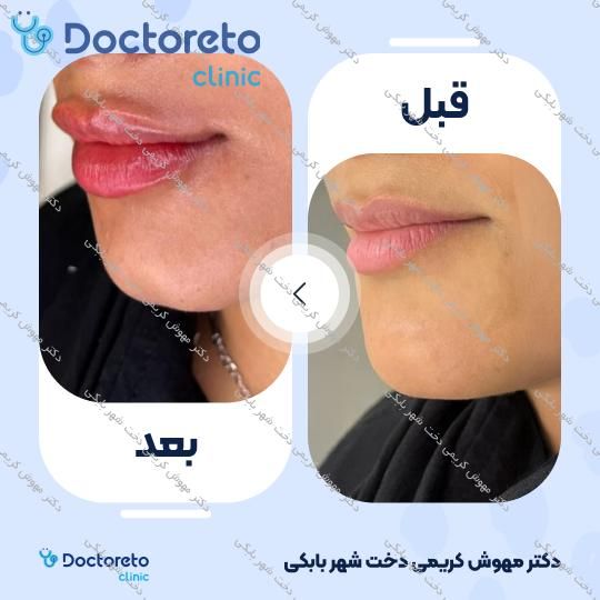 تزریق ژل لب