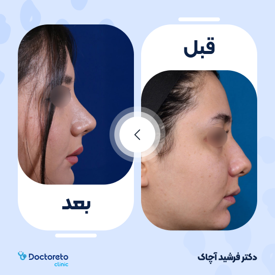 عمل زیبایی بینی گوشتی (رینوپلاستی)