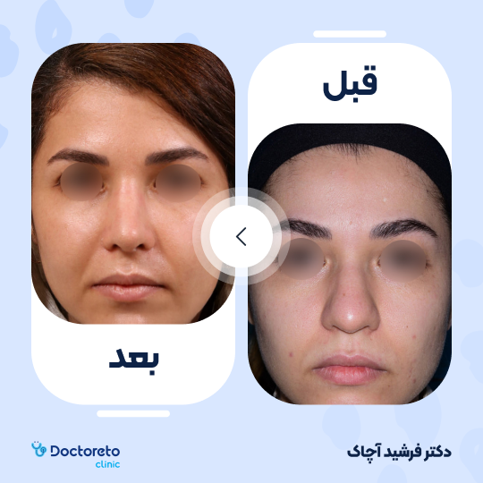 عمل زیبایی بینی گوشتی (رینوپلاستی)