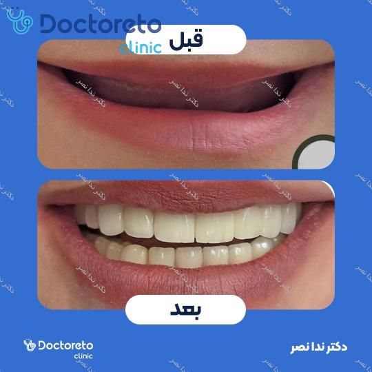 ایمپلنت دندان با روکش (هر واحد)