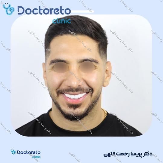 جرم گیری دو فک با بروساژ زیر لثه