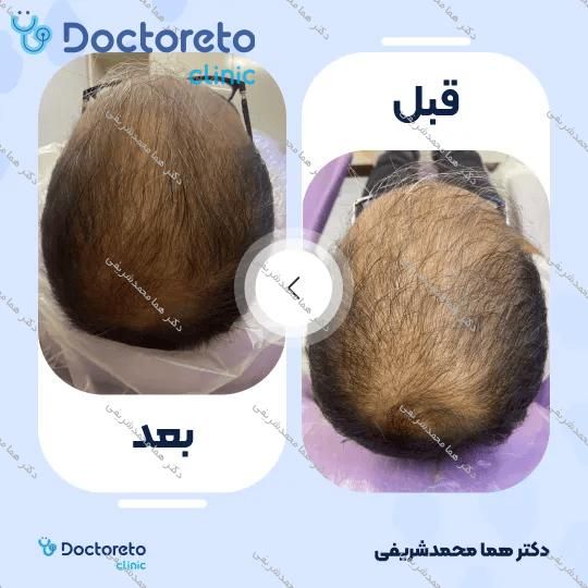درمان ریزش موی سر با تزریق مزوتراپی (هرجلسه)