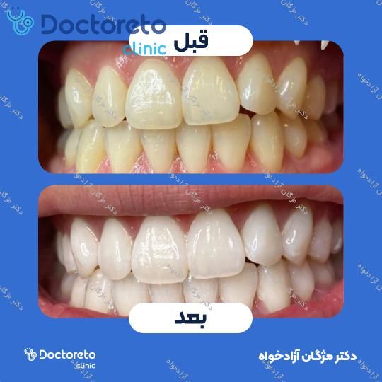 بلیچینگ دندان (سفید کردن دندان)