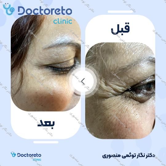تزریق بوتاکس صورت (پیشانی، خط اخم، پنجه کلاغی)💉