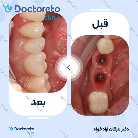 روکش دندان (هر واحد)