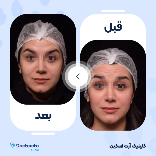 تزریق بوتاکس صورت (پیشانی، خط اخم، پنجه کلاغی)💉