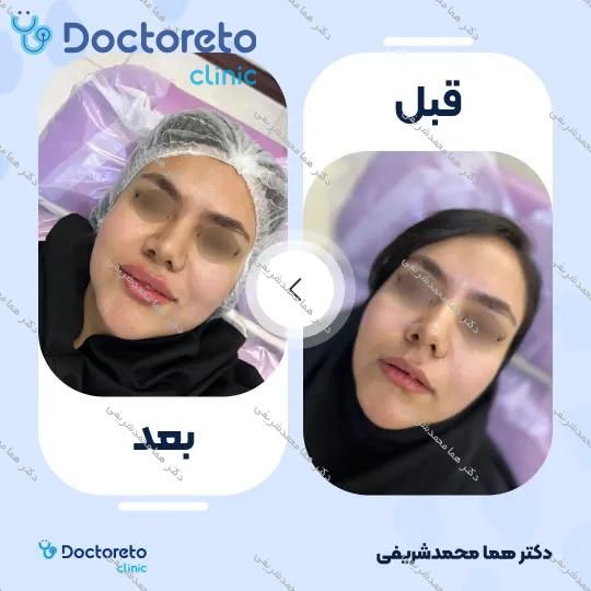 تزریق ژل لب