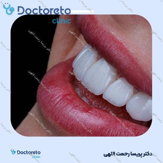 لمینت دندان (هر واحد)