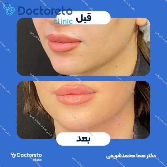 تزریق ژل لب