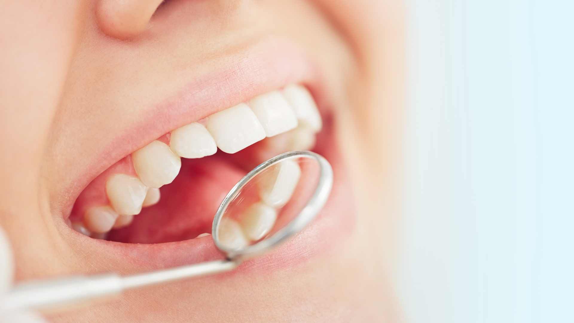 لمینت دندان (هر واحد)