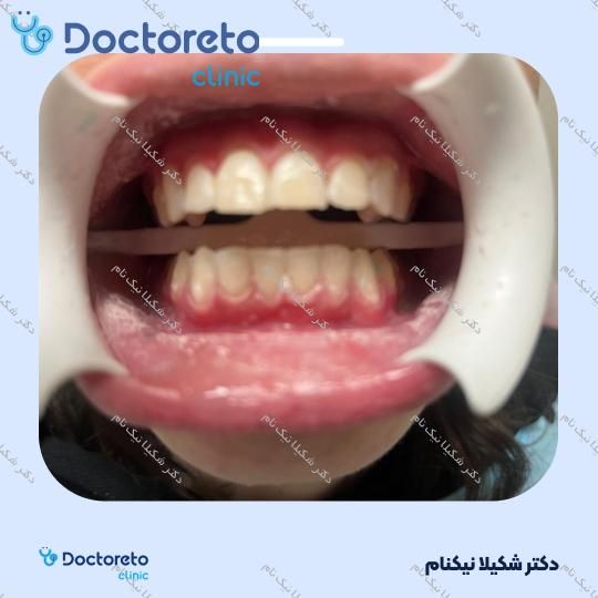 بلیچینگ دندان (سفید کردن دندان)