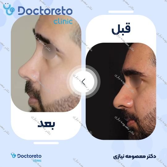 عمل جراحی زیبایی بینی گوشتی (رینوپلاستی)