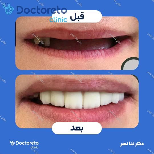 ایمپلنت دندان با روکش (هر واحد)