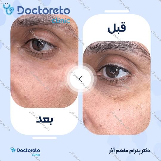 تزریق ژل زیرچشم