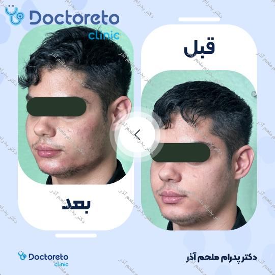 تزریق ژل زاویه فک