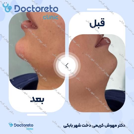 تزریق ژل خط خنده