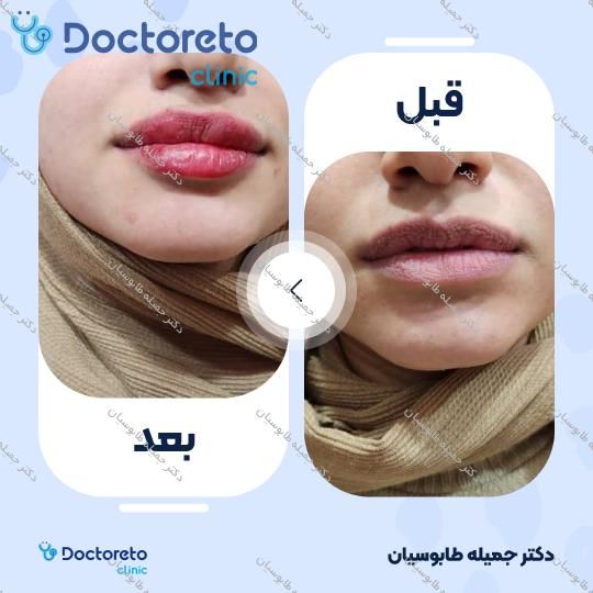 تزریق ژل لب