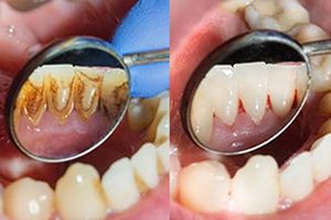 جرم گیری کامل دندان‌های دو فک با بروساژ🦷