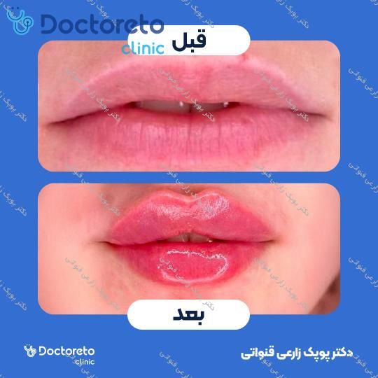 تزریق ژل لب