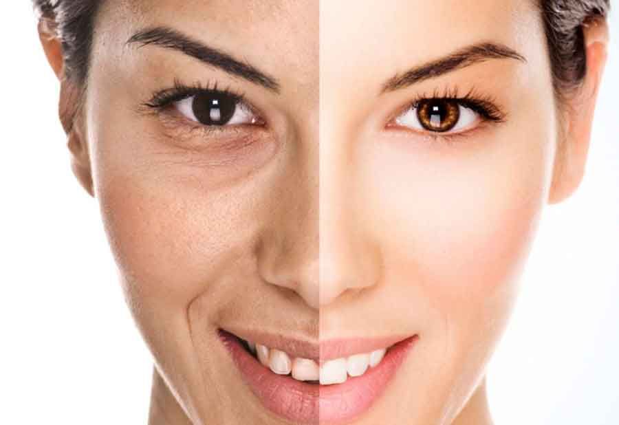 جوانسازی و روشن سازی صورت به روش کربوکسی تراپی (هرجلسه)