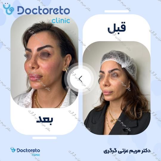 تزریق ژل گونه