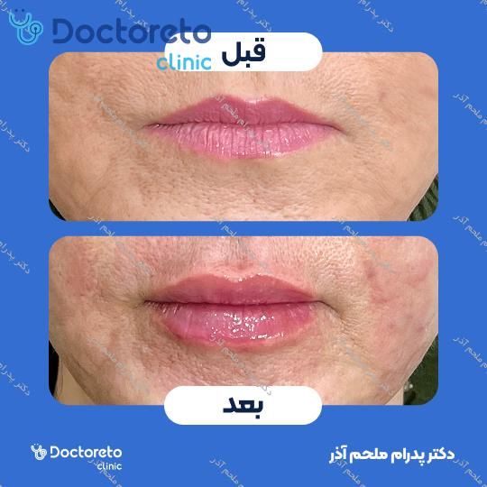 تزریق ژل لب