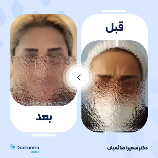 تزریق بوتاکس صورت (پیشانی، خط اخم، پنجه کلاغی)💉