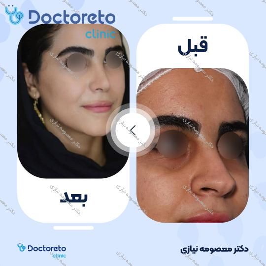 عمل جراحی زیبایی بینی نیمه فانتزی (رینوپلاستی)