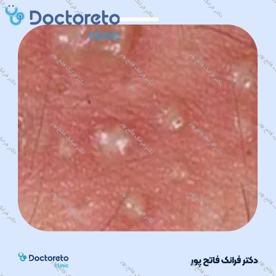 برداشتن زگیل تناسلی بانوان (هر عدد)