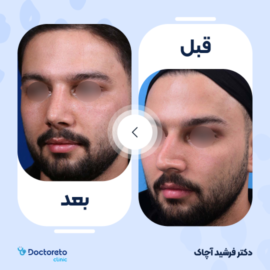 عمل جراحی ترمیمی زیبایی بینی (رینوپلاستی)