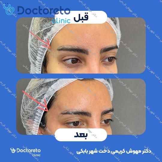 تزریق ژل شقیقه