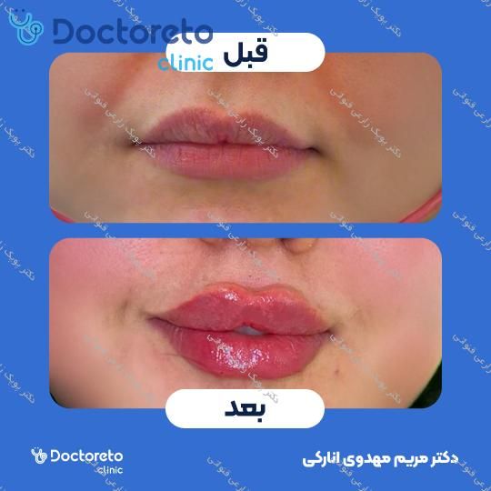 تزریق ژل لب