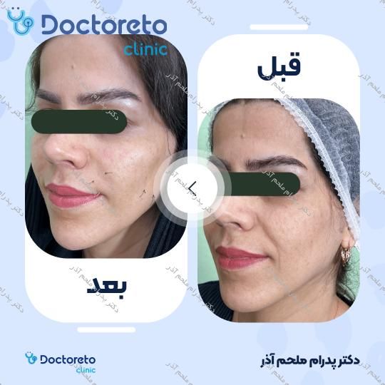 تزریق ژل خط خنده