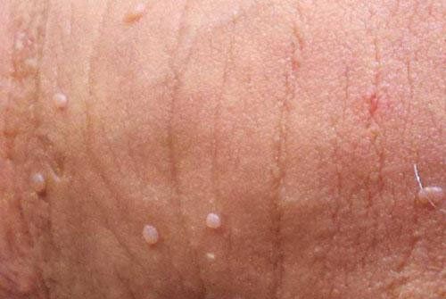 برداشتن زگیل تناسلی بانوان