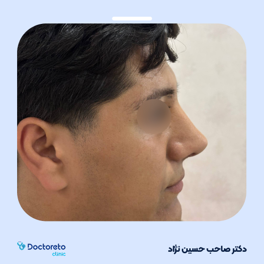 عمل جراحی مجدد زیبایی بینی (رینوپلاستی)