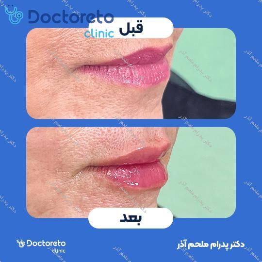 تزریق ژل لب