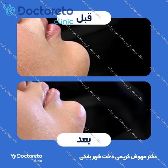 تزریق ژل چانه