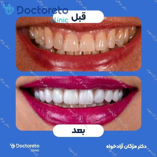 کامپوزیت دندان (هر واحد)