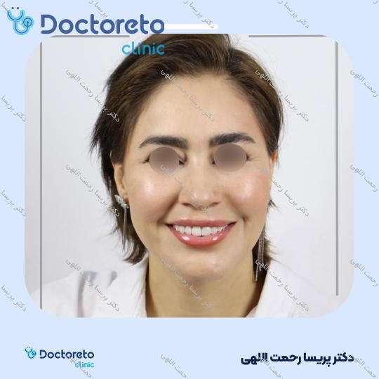 لمینت دندان (هر واحد)