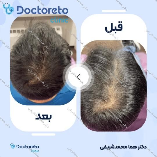 جوانسازی و روشن سازی سیاهی دور چشم با روش پلاسما تراپی