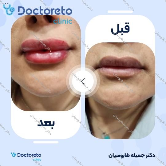 تزریق ژل لب