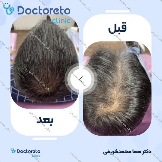 جوانسازی و روشن سازی سیاهی دور چشم با روش پلاسما تراپی