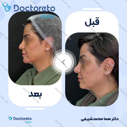 تزریق ژل چانه