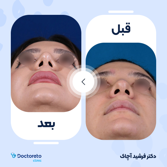 عمل زیبایی بینی گوشتی (رینوپلاستی)