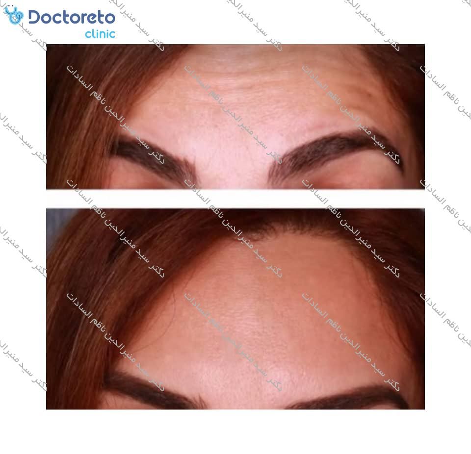 تزریق بوتاکس صورت (پیشانی، خط اخم، پنجه کلاغی)💉